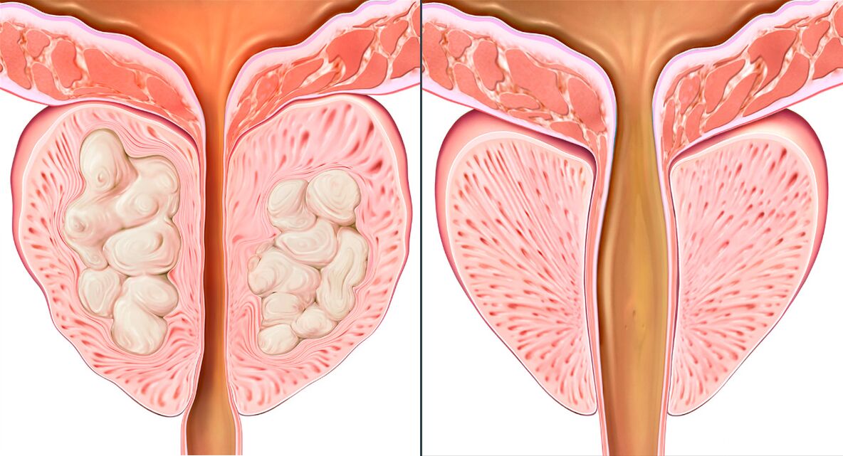 Етапи на курса на лечение на простатит с Prostalix